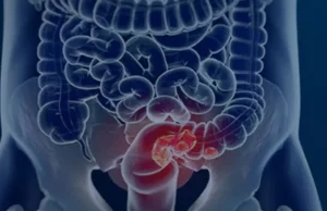 Rastreamento para câncer colorretal pode ser implementado no SUS