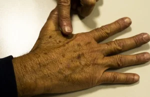 Desinformação sobre câncer de pele afeta diagnóstico, diz instituição